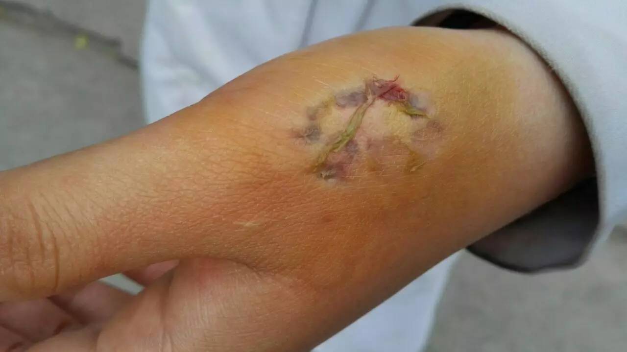 精神科护士有效防范咬伤约束是关键